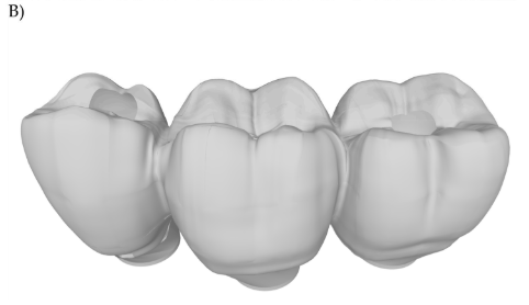 Figura 2 (B) 3D model of the 3-unit fixed partial denture.